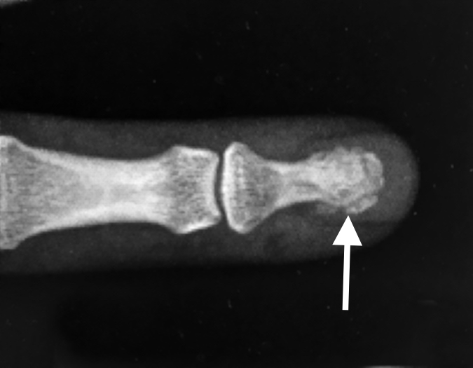 Distal phalanx tuft fracture (arrow) AP view
