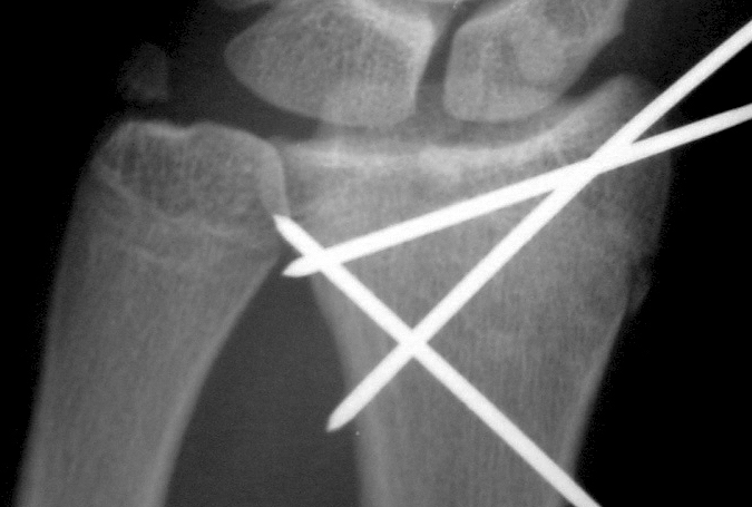 Intra-articular displaced distal radius fracture reduced and secured with pins and external fixation.