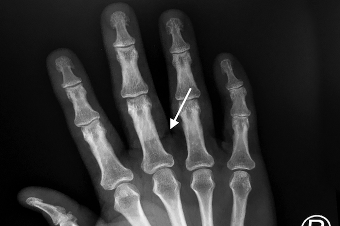 Dog Bite X-Ray shows air in open wound (arrow) with fractures.