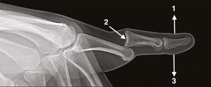 The closed reduction maneuver for the dorsal PIP joint dorsal dislocation involves hyperextending the PIP joint (1), while applying pressure to push the base of the middle phalanx distally until it is beyond the head of the proximal phalanx and can fall back into the reduced position. Once the joint starts to relocate, then the middle phalanx is flexed while the traction is maintained on the distal part of the finger.