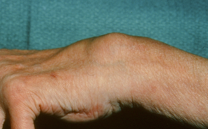 Dorsal Tenosynovitis Left Wrist