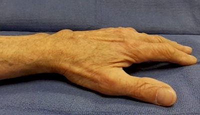 Dorsal Tenosynovitis caused by hypertrophic tenosynovium attached to the extensor tendons of the left wrist.