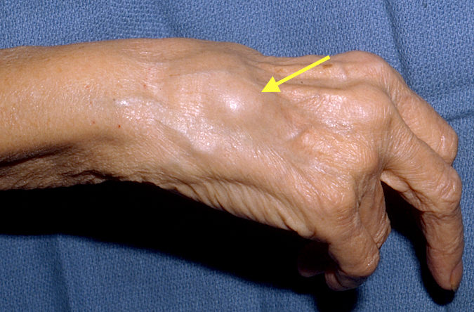 Dorsal Tenosynovitis Right Wrist at Arrow extends proximally to extensor retinaculum