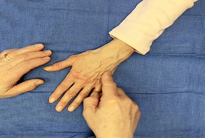 Dorsal ulnar nerve sensation being tested ulnar dorsal hand and little finger.