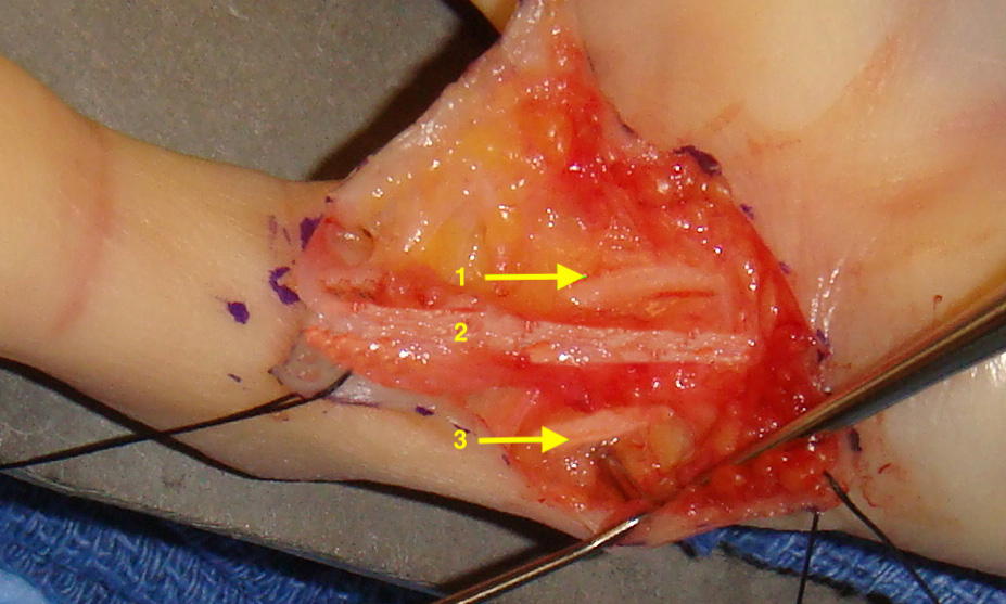 Dorsal ulnar sensory nerve as seen during Dupuytren's fasciectomy for a Abductor Digiti Minimi cord (2). Little finger ulnar digital nerve (1); Dorsal ulnar sensory nerve (3).