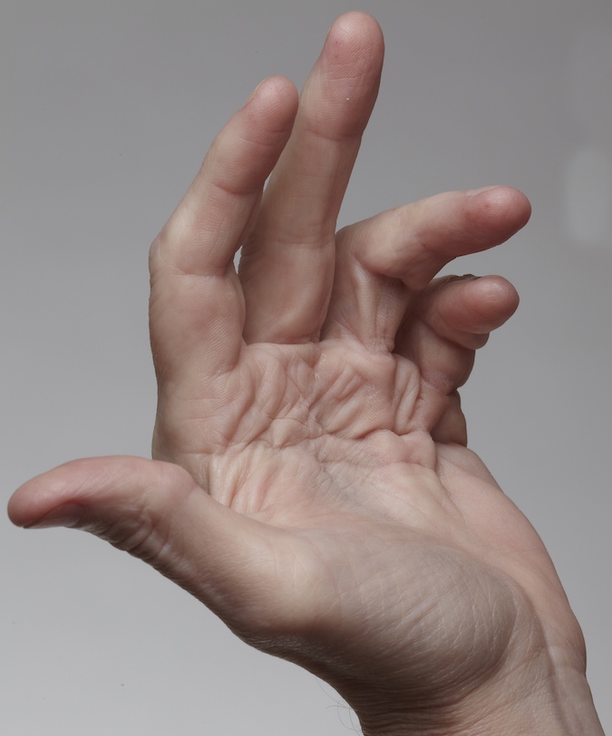 Dupuytren's Contracture ring and fifth finger caused by two separate central cords