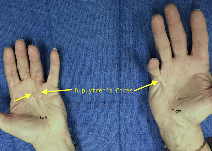 Dupuytren's Cords limiting left long and ring and right little finger extension which will cause positive Table Top Tests (TTT).