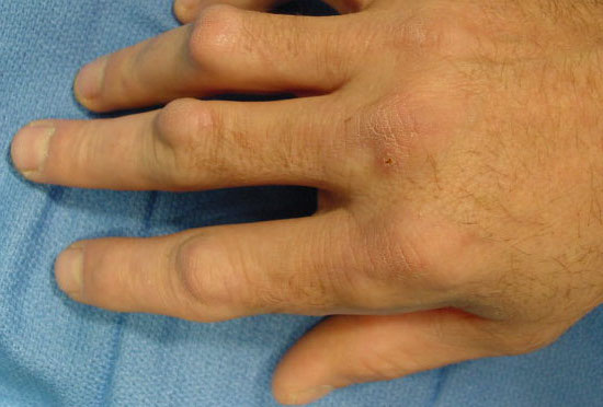 Dupuytren's knuckle pads on dorsum of PIP joints. Sometimes first clinical sign of Dupuytren's Disease.