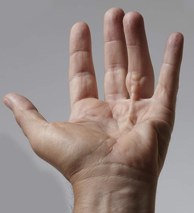 Dupuytren's Contracture ring finger caused by central cord