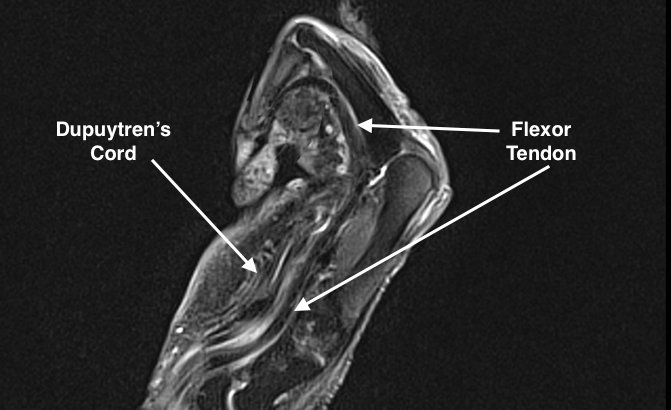 Xray and MRI imaging is rarely needed in Dupuytren's disease but in recurrent contractures after fasciectomy it may necessary to distinguish a Dupuytren's cord from a displaced flexor tendon with a ruptured A-2 pulley.