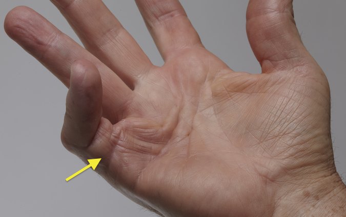 Dupuytren's Contracture fifth finger caused by an Abductor Digiti Minimi Cord