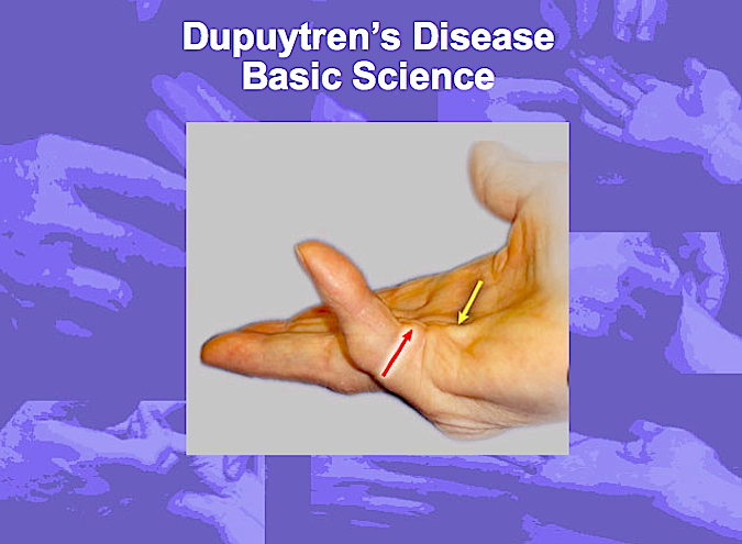 Dupuytren's Disease Basic Science