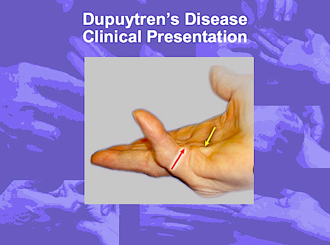 Clinical presentation of Dupuytren's Disease