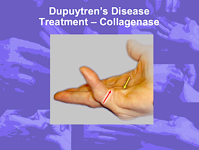 Collagenase Treatment for Dupuytren's Disease