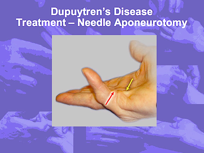 Needle Aponeurotomy