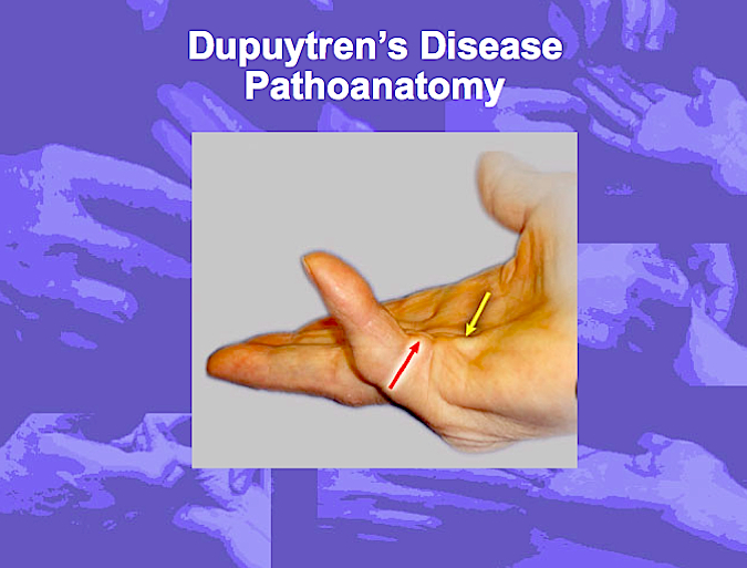 The Pathoanatomy of Dupuytren's Disease