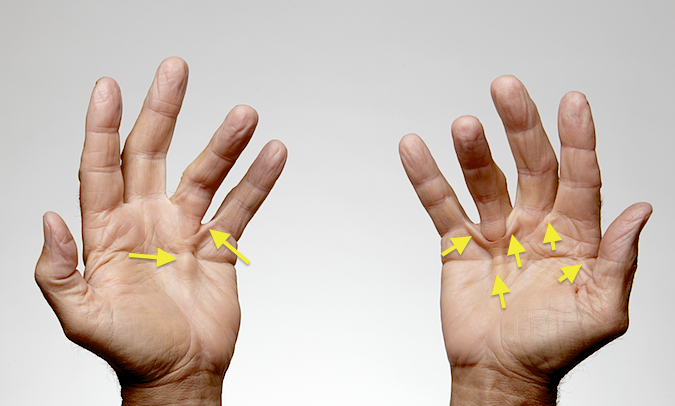 Dupuytren's Contracture with left ring central cord and natatory cord to fifth finger. On right there is a thumb-index commissurral cord, natatory cords to index, long and fifth fingers with central cord to ring.