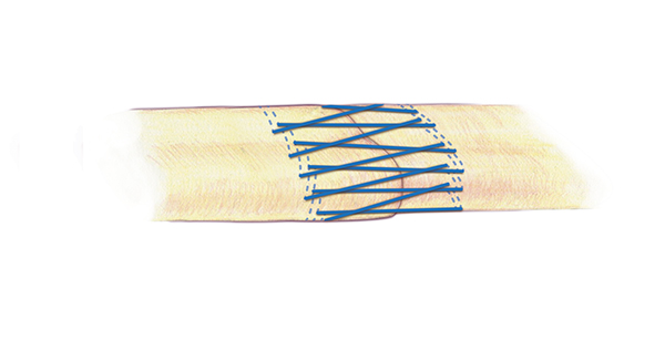 A separate second suture for the edge  or epitenon part of the extensor repair is very important.  This locking Cross-Silferskiold suture is another appropriate suture technique for this repair .  A 6-O nylon is one acceptable suture for the epitenon repair.