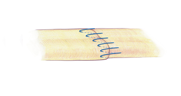 A separate second suture for the edge  or epitenon part of the extensor repair is very important.  This simple running suture is appropriate suture technique for this repair .  A 6-O nylon is one acceptable suture for the epitenon repair.