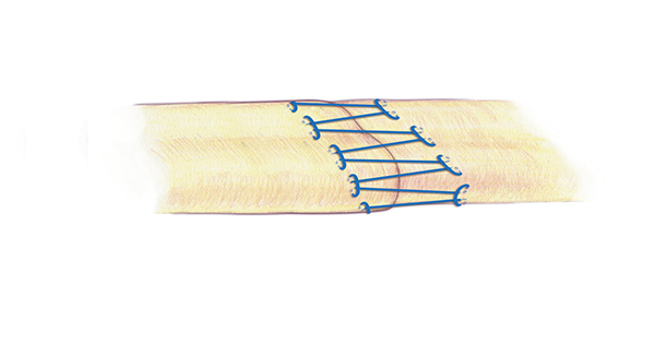 A separate second suture for the edge  or epitenon part of the extensor repair is very important.  This simple running locking suture is another appropriate suture technique for this repair .  A 6-O nylon is one acceptable suture for the epitenon repair.