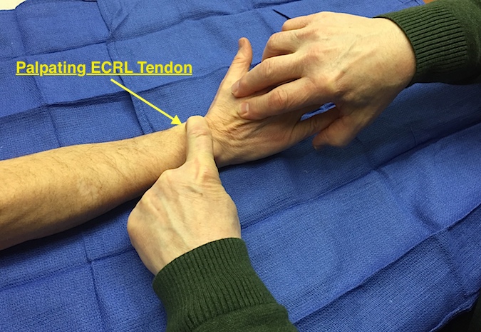 ECRL Muscle Test. Tendon palpated at RC join level while patient extends wrist against resistance.