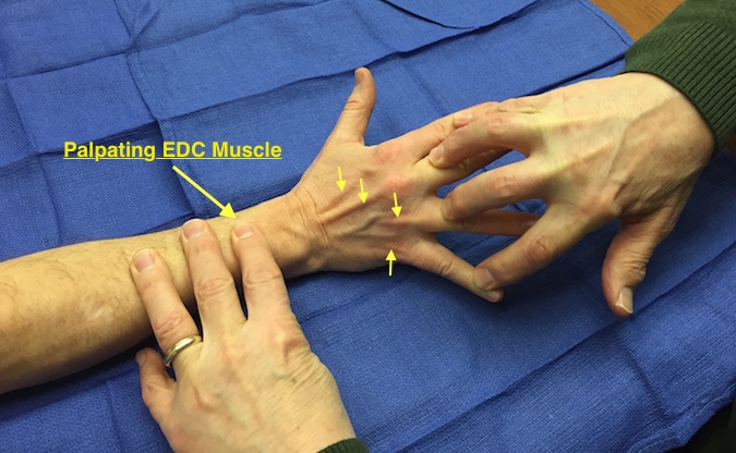 EDC Muscle Testing. Small arrows EDC tendons