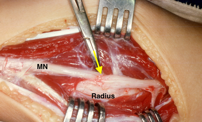  Median Nerve (MN) encased in radial fracture callus (arrow).