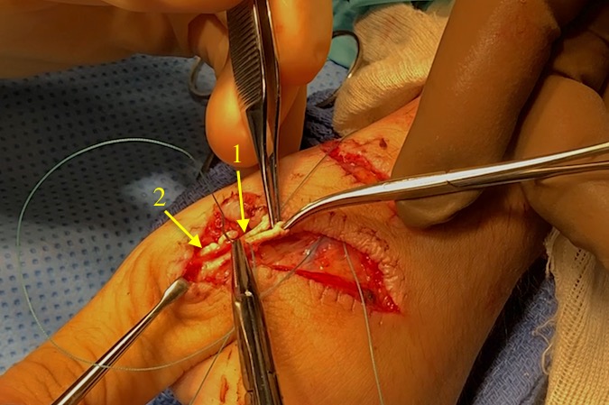 EPL core suture (1) of 3-O braided non-absorbable being placed.  Note distal end of EPB (2).