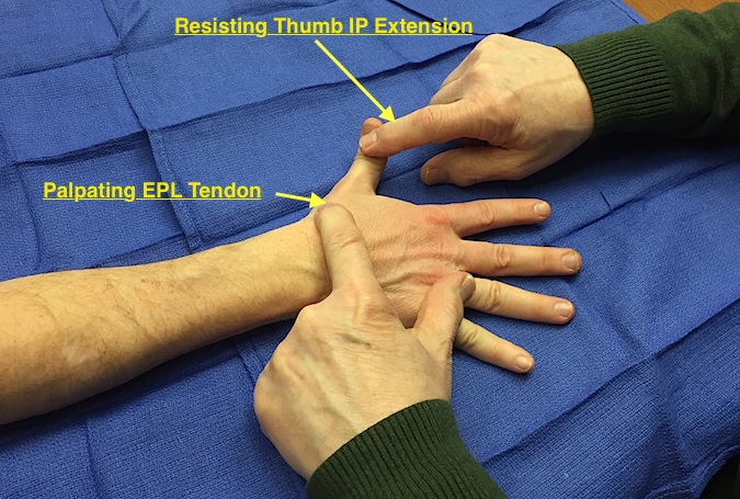EPL Muscle Testing. Note EPL tendon visible and palpable