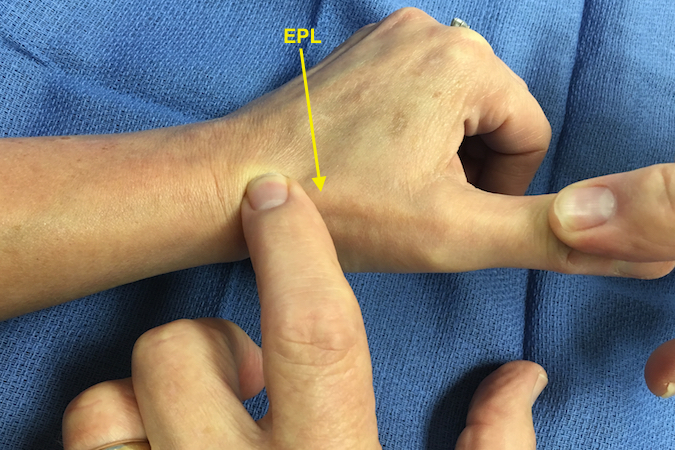 EPL Exam - Thumb extended off plane of table. Extensor Pollicis longus (EPL) visible under skin.