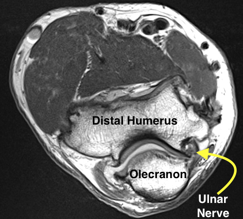 Elbow MRI Cross Section - Note medial posterior position of the Ulnar Nerve