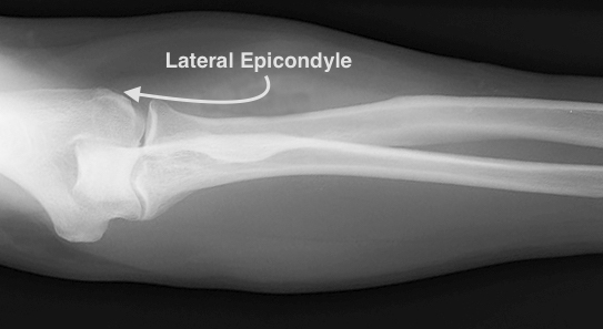 In tennis elbow the X-ray of the elbow is usually normal. Occasion calcifications of the extensor origin will be seen.
