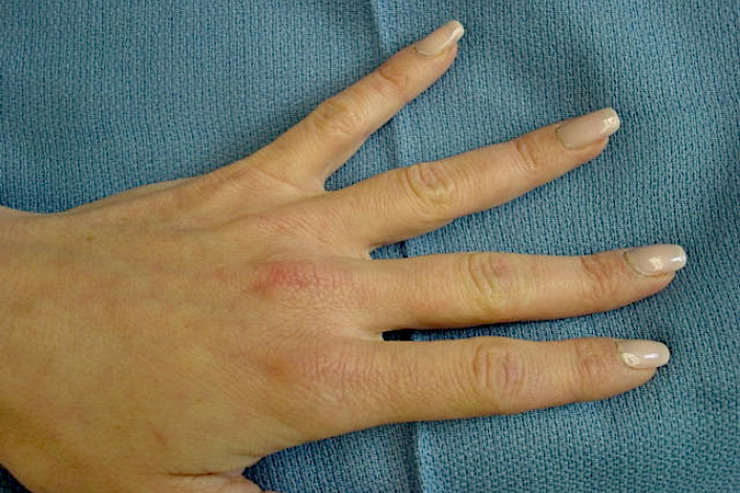 Enchondroma - ring finger with no obvious change in but tender over middle phalanx