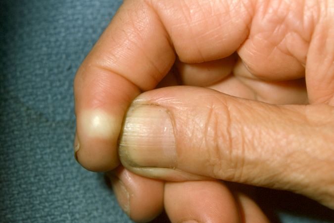 Epidermoid Cyst in tip of right index finger. Note how the white color of the cyst shows through the epidermis as the skin is pulled tight over the firm mass.