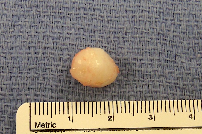 An epidermoid cyst surgical specimen before submission to pathology.