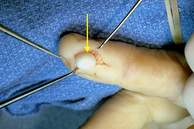 The epidermoid cyst (arrow) has been dissect free from the majority of the fingertip pulp and is ready for final excision. The neurovascular bundle has been protect in the dorsal radial tissues.