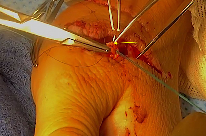 Epitendinous peripheral edge 6-O nylon suture (arrow) being placed.