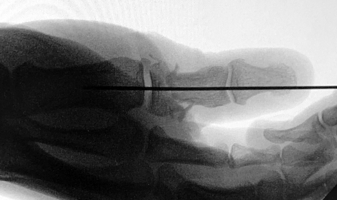 X-ray AP thumb for thumb extensor laceration and associated open fracture after ORIF of proximal phalanx.