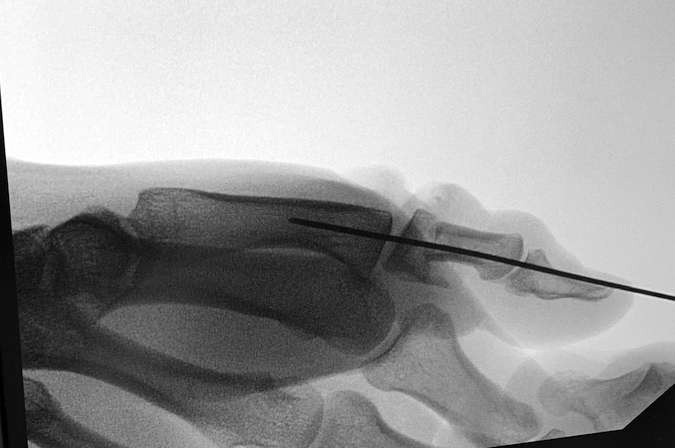 X-ray Lateral thumb for thumb extensor laceration and associated open fracture after ORIF of proximal phalanx.