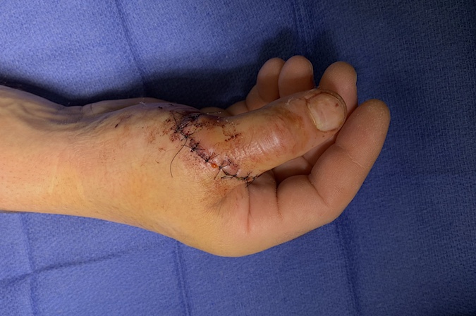 Middle aged carpenter with a power saw injury to the right thumb.  Irrigated, debrided, temporarily closed & placed on IV antibiotics prior to definitive repairs.