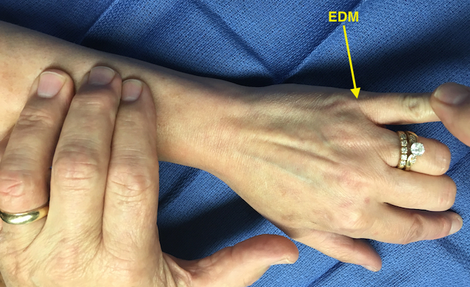 Extensor digiti  minimi (EDM) extending little finger MP while long and ring held in flexion.