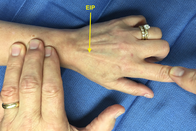 Extensor Indicis Proprius (EIP) extending index MP while long and ring held in flexion and examiner's left hand fingers palpate the muscle belly