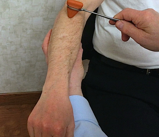 Brachioradialis (Extensor) Reflex (C6) at right elbow