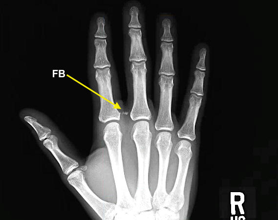Retained glass after laceration near base of right index finger.