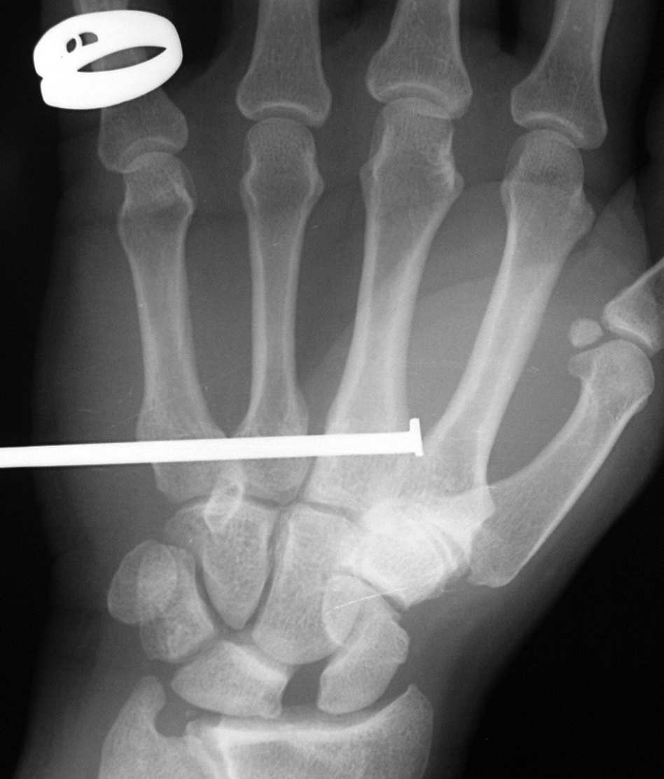 Nail Gun Injury X-ray Hand. Note incidental S-L gap.