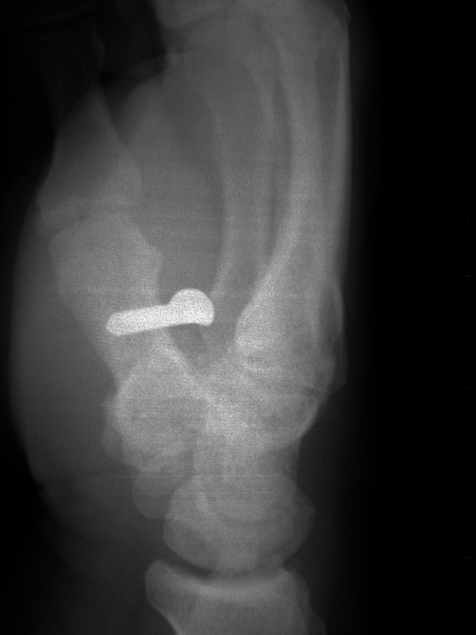 Nail Gun Injury X-ray Right Hand