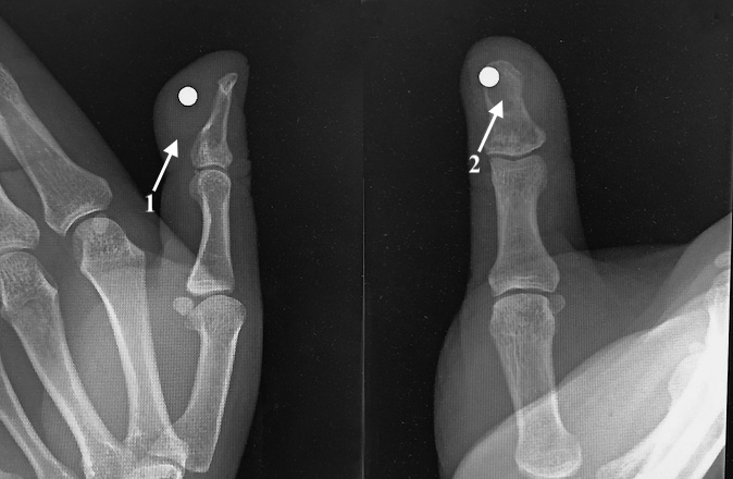 Retained FB (pellet) present for 20 years.  Note (1) vague soft tissue shadow from granuloma and (2) bony changes in distal phalanx