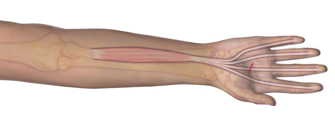 This illustration represents the anatomy of the muscle and tendon origin and insertion. Should an individual sustain a laceration as depicted, the observer can assume that the underlying tendon may be at risk for complete transection. A proper examination is needed to determine the integrity of the tendon.