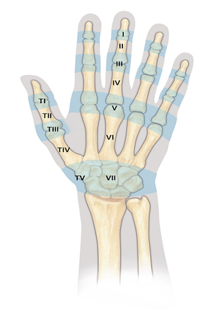 Extensor Tendon Zones of Injury. Zone I to Zone VII for the fingers, hand and wrist.  Zones TI to Tv for the thumb.