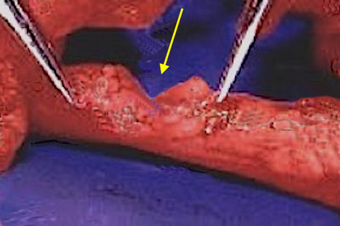  Median Nerve partial laceration  (arrow).